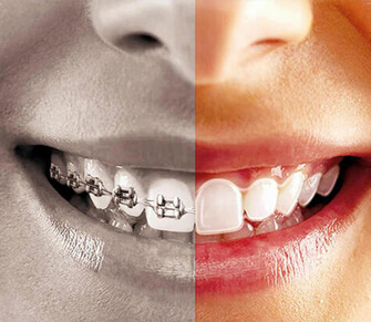 Ortodonti (Diş Teli)
